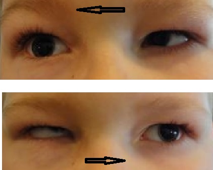 5 år gammel barn med Duanes Syndrome på begge øjne. Øjnene kan ikke drejes udad og samtidig kniber det modsatte øje sammen.
